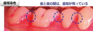 歯垢染色